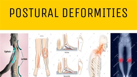 physical deformity